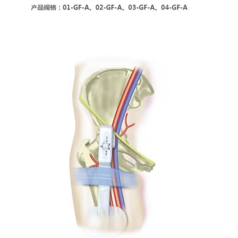 Goldfinger Electronic Hemostasis Compression Dispozitiv Femural