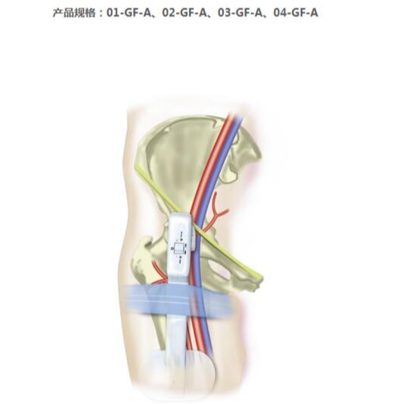 Goldfinger Electronic Hemostasis Compression Dispozitiv Femural