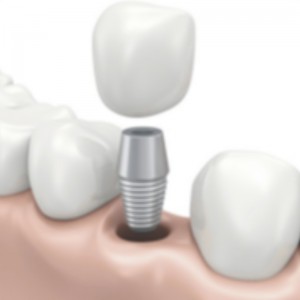 implant dentar